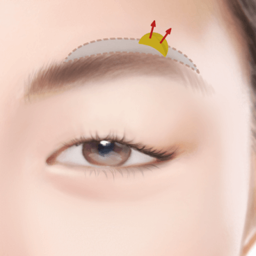 https://beauty.findclinic.kr/wp-content/uploads/sites/14/2020/05/above-eyebrow02.png