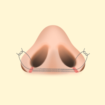 https://beauty.findclinic.kr/wp-content/uploads/sites/14/2020/05/alar-reduction-process03.png