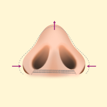 https://beauty.findclinic.kr/wp-content/uploads/sites/14/2020/05/alar-reduction-process04.png