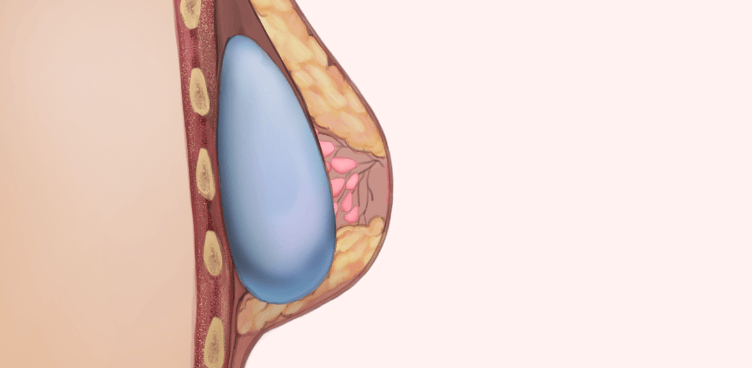 https://beauty.findclinic.kr/wp-content/uploads/sites/14/2020/05/breast-augment-process01.png