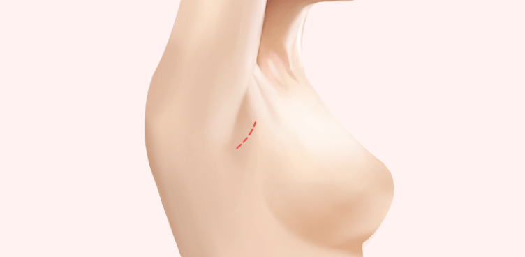https://beauty.findclinic.kr/wp-content/uploads/sites/14/2020/05/breast-augment-process04.png