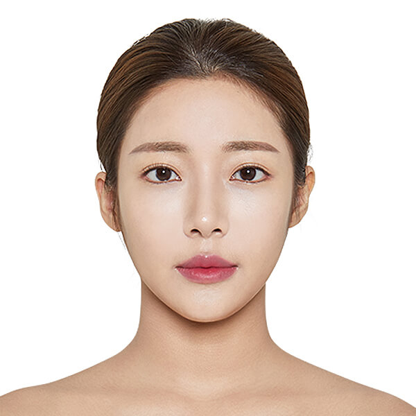 https://beauty.findclinic.kr/wp-content/uploads/sites/14/2020/05/double-after01.jpg