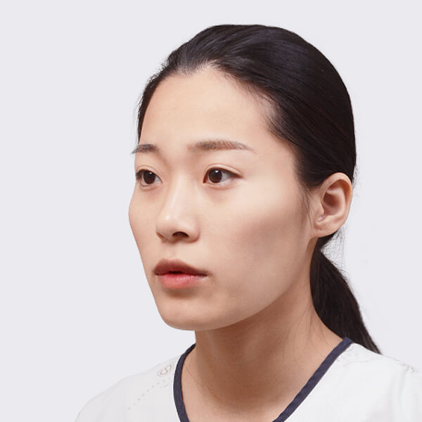https://beauty.findclinic.kr/wp-content/uploads/sites/14/2020/05/double-before02.jpg