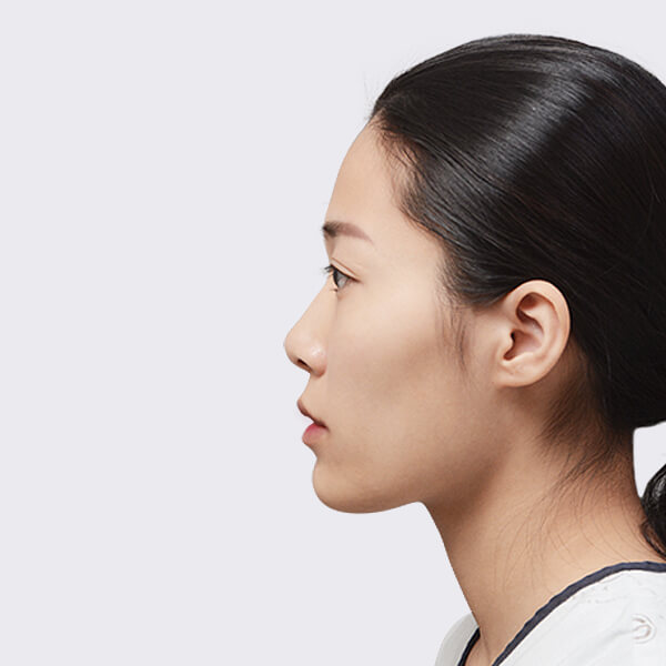 https://beauty.findclinic.kr/wp-content/uploads/sites/14/2020/05/double-before03.jpg