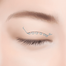 https://beauty.findclinic.kr/wp-content/uploads/sites/14/2020/05/double-lock-process02.png
