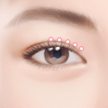 https://beauty.findclinic.kr/wp-content/uploads/sites/14/2020/05/double-lock-process03.png