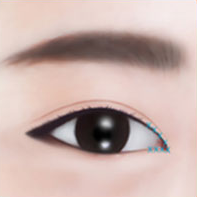 https://beauty.findclinic.kr/wp-content/uploads/sites/14/2020/05/epi-process04-1.png