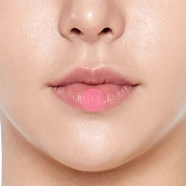 https://beauty.findclinic.kr/wp-content/uploads/sites/14/2020/05/fat-grafting-applied08.png