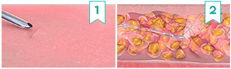 https://beauty.findclinic.kr/wp-content/uploads/sites/14/2020/05/harvest-jet-transplant-cut01.png