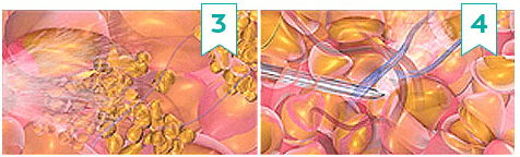 https://beauty.findclinic.kr/wp-content/uploads/sites/14/2020/05/harvest-jet-transplant-cut02.png