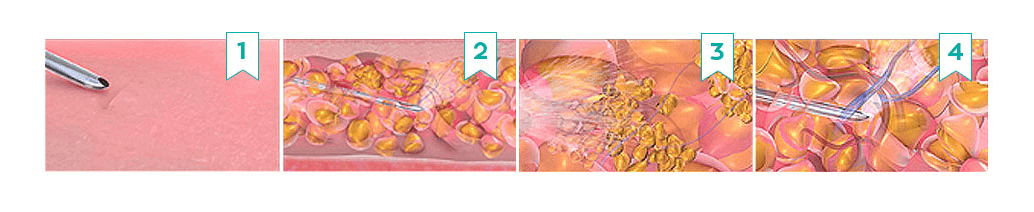 https://beauty.findclinic.kr/wp-content/uploads/sites/14/2020/05/harvest-jet-transplant.png