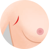 https://beauty.findclinic.kr/wp-content/uploads/sites/14/2020/05/implant-breast-incision01.png