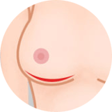 https://beauty.findclinic.kr/wp-content/uploads/sites/14/2020/05/implant-breast-incision03.png