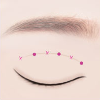 https://beauty.findclinic.kr/wp-content/uploads/sites/14/2020/05/incision-double-process03.png