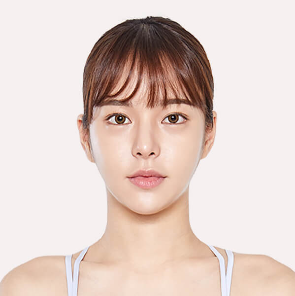 https://beauty.findclinic.kr/wp-content/uploads/sites/14/2020/05/lifting-after01-1.jpg