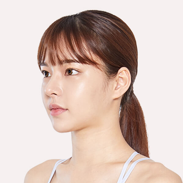 https://beauty.findclinic.kr/wp-content/uploads/sites/14/2020/05/lifting-after02.jpg