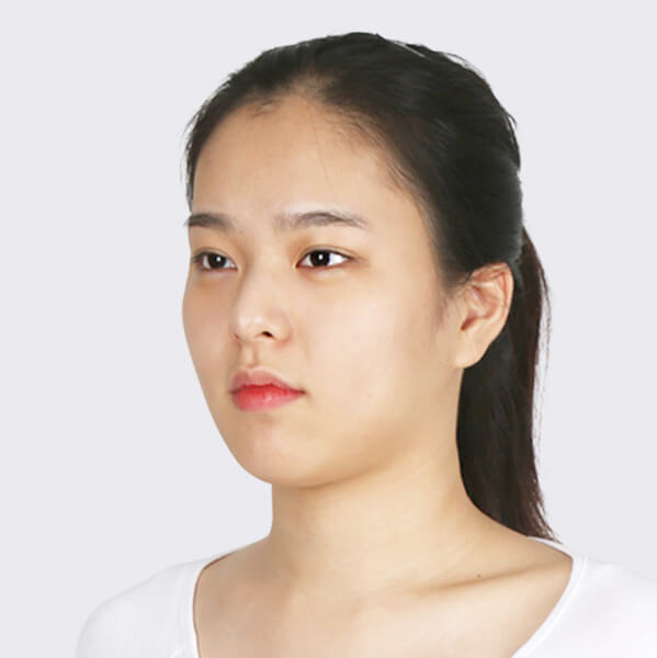 https://beauty.findclinic.kr/wp-content/uploads/sites/14/2020/05/lifting-before02.jpg