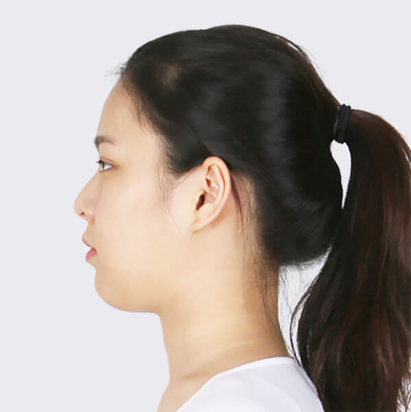 https://beauty.findclinic.kr/wp-content/uploads/sites/14/2020/05/lifting-before03.jpg