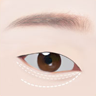 https://beauty.findclinic.kr/wp-content/uploads/sites/14/2020/05/lower-eye-process02.png
