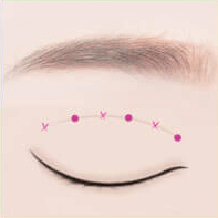 https://beauty.findclinic.kr/wp-content/uploads/sites/14/2020/05/quick-burial-process04.png