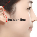 https://beauty.findclinic.kr/wp-content/uploads/sites/14/2020/05/smas-lifting-process01.png