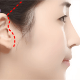 https://beauty.findclinic.kr/wp-content/uploads/sites/14/2020/05/smas-lifting-process03.png