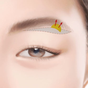 https://beauty.findclinic.kr/wp-content/uploads/sites/14/2020/05/under-eyebrow03.png