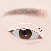 https://beauty.findclinic.kr/wp-content/uploads/sites/14/2020/05/upper-eye-process02.png