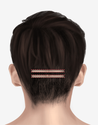 https://beauty.findclinic.kr/wp-content/uploads/sites/14/2020/06/back-of-scalp02.png