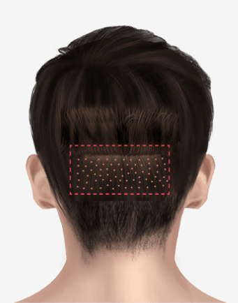 https://beauty.findclinic.kr/wp-content/uploads/sites/14/2020/06/back-of-scalp03.png