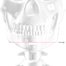 https://beauty.findclinic.kr/wp-content/uploads/sites/14/2020/06/chin-process-05.png
