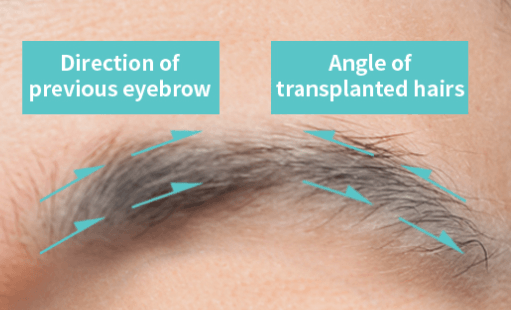 https://beauty.findclinic.kr/wp-content/uploads/sites/14/2020/06/direction-of-eyebrow02.png