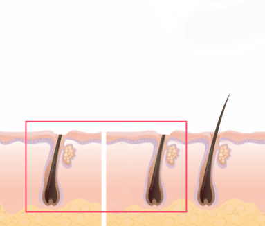 https://beauty.findclinic.kr/wp-content/uploads/sites/14/2020/06/double-suture-hair01.png