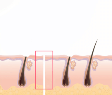 https://beauty.findclinic.kr/wp-content/uploads/sites/14/2020/06/double-suture-hair02.png