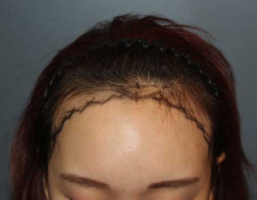 https://beauty.findclinic.kr/wp-content/uploads/sites/14/2020/06/hairline-correction01.jpg