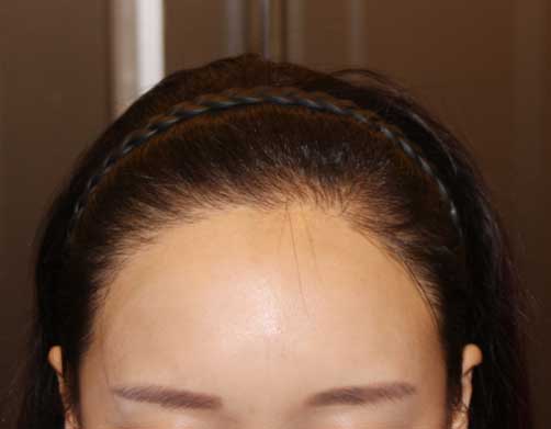 https://beauty.findclinic.kr/wp-content/uploads/sites/14/2020/06/hairline-correction02.jpg