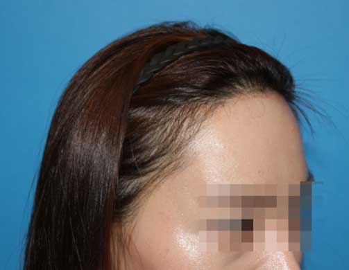 https://beauty.findclinic.kr/wp-content/uploads/sites/14/2020/06/magic-forehead-img02.jpg