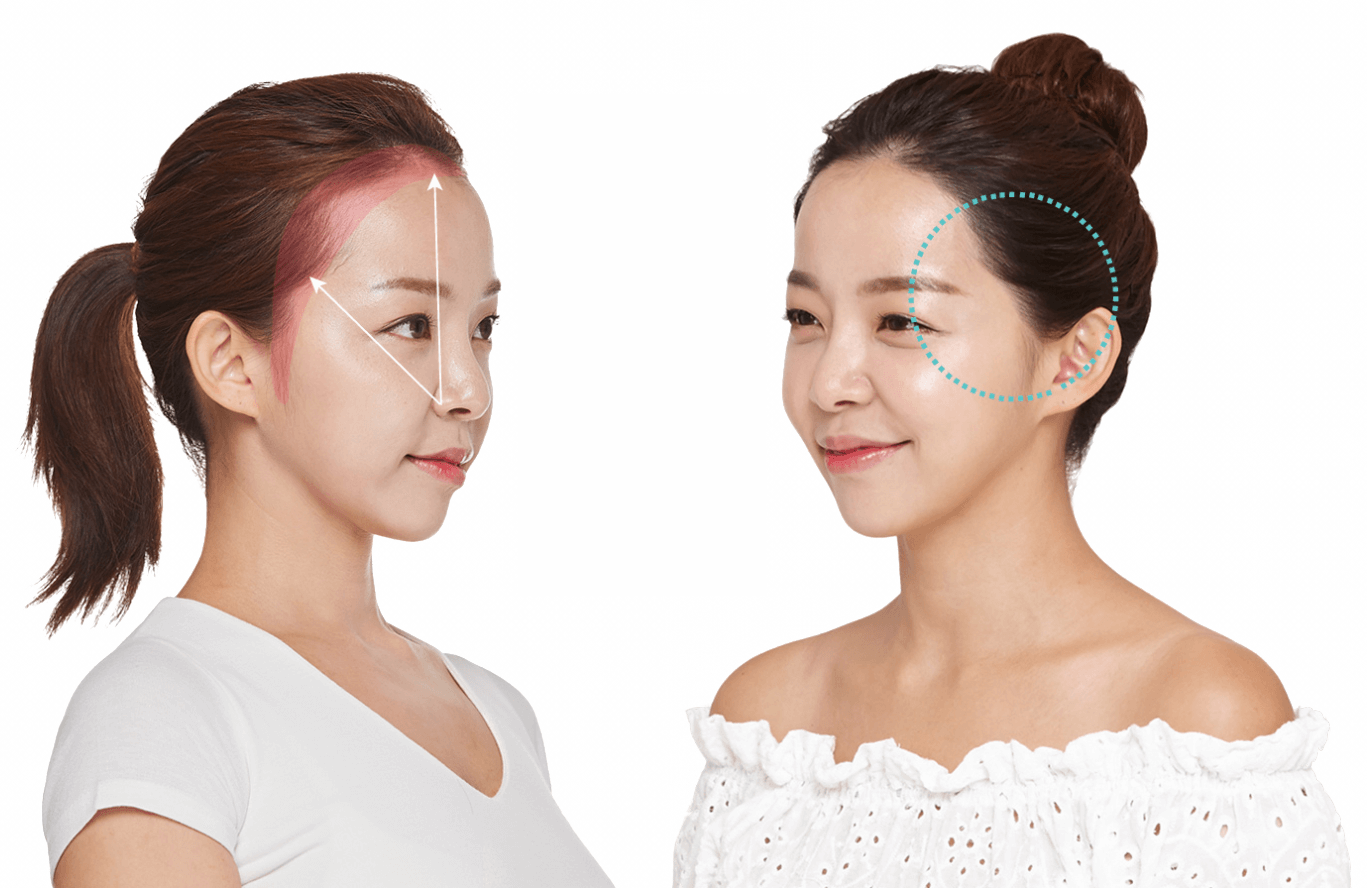 https://beauty.findclinic.kr/wp-content/uploads/sites/14/2020/06/side-hair-correction0.png
