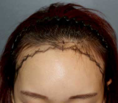 https://beauty.findclinic.kr/wp-content/uploads/sites/14/2020/06/sideburns-transpalnt01.jpg