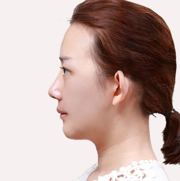 https://beauty.findclinic.kr/wp-content/uploads/sites/14/2020/06/skin-after03.jpg