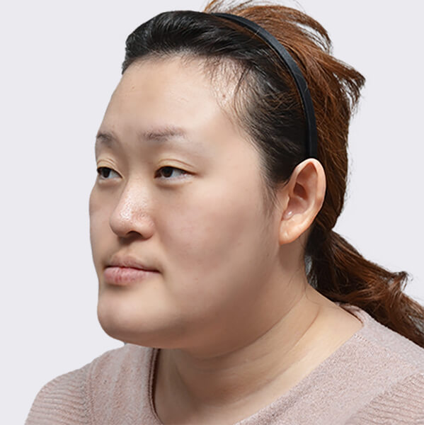 https://beauty.findclinic.kr/wp-content/uploads/sites/14/2020/06/skin-before02.jpg