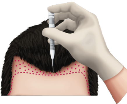 https://beauty.findclinic.kr/wp-content/uploads/sites/14/2020/06/two-rich-hair02.png