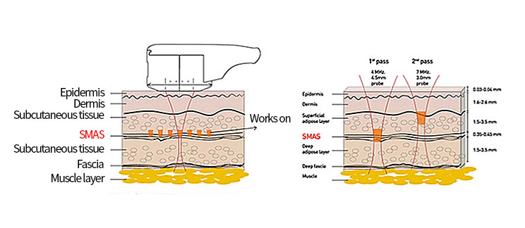 https://beauty.findclinic.kr/wp-content/uploads/sites/14/2020/07/doublo-s-treatment.png